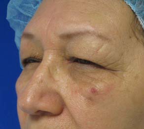 Eyelid Surgery