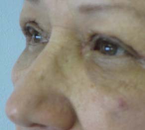 Eyelid Surgery