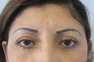 Eyelid Surgery