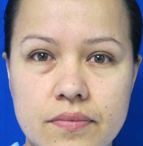 Eyelid Surgery
