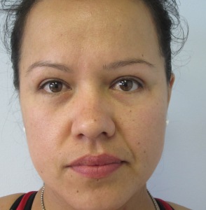Eyelid Surgery