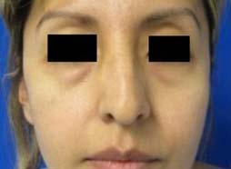 Eyelid Surgery
