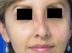 Eyelid Surgery