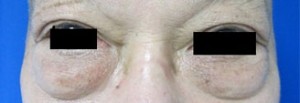 Eyelid Surgery