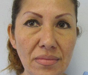 Eyelid Surgery