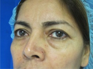Eyelid Surgery