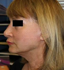 Neck Lift