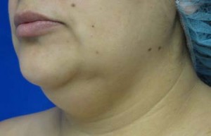 Neck Lift