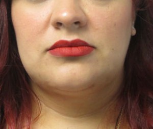 Neck Lift
