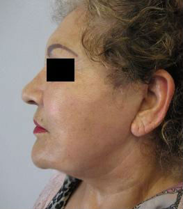 Neck Lift