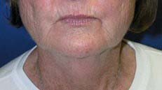 Neck Lift