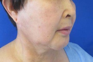 Neck Lift