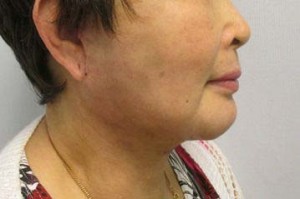 Neck Lift