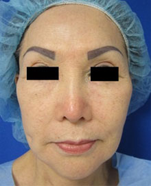 Facial Fat Grafting and Stem Cell Rejuvenation