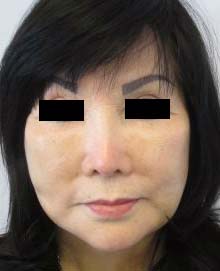 Facial Fat Grafting and Stem Cell Rejuvenation