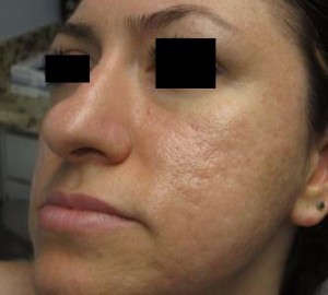 Facial Fat Grafting and Stem Cell Rejuvenation