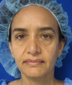 Facial Fat Grafting and Stem Cell Rejuvenation