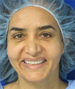 Facial Fat Grafting and Stem Cell Rejuvenation