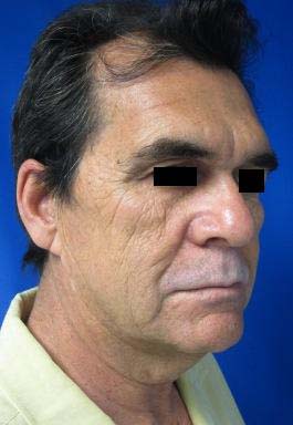 Facial Fat Grafting and Stem Cell Rejuvenation