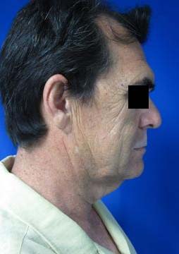 Facial Fat Grafting and Stem Cell Rejuvenation