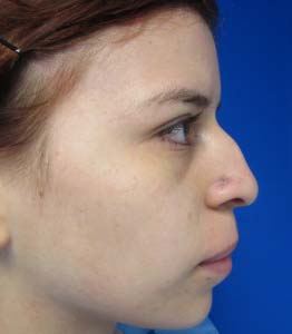 Rhinoplasty
