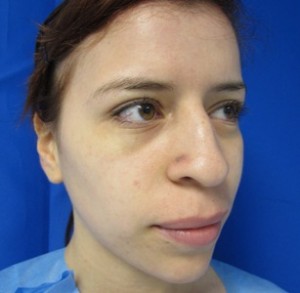 Rhinoplasty