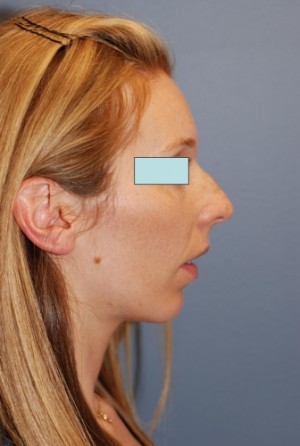 Rhinoplasty