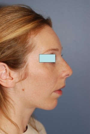 Rhinoplasty