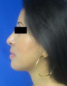 Rhinoplasty