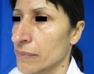 Rhinoplasty
