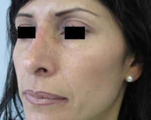 Rhinoplasty