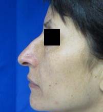 Rhinoplasty