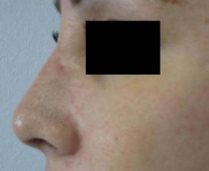 Rhinoplasty