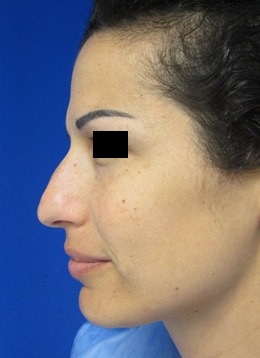 Rhinoplasty