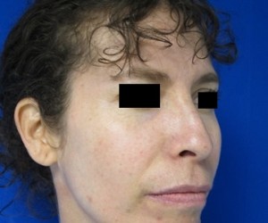 Rhinoplasty