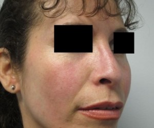 Rhinoplasty