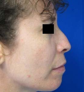 Rhinoplasty