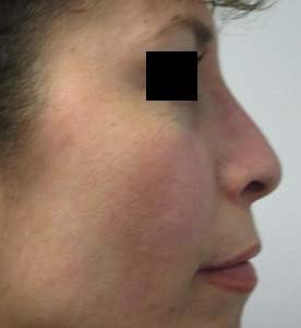 Rhinoplasty