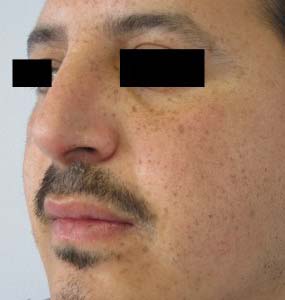 Rhinoplasty