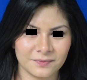 Rhinoplasty