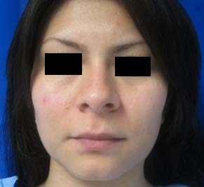 Rhinoplasty