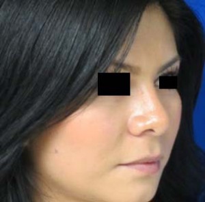 Rhinoplasty