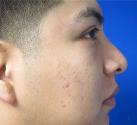 Rhinoplasty
