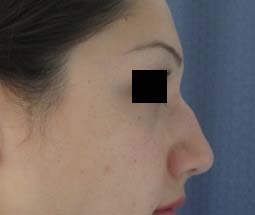 Rhinoplasty