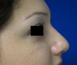 Rhinoplasty