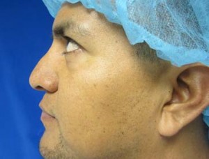 Rhinoplasty