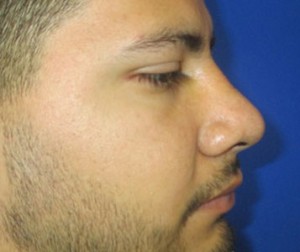 Rhinoplasty