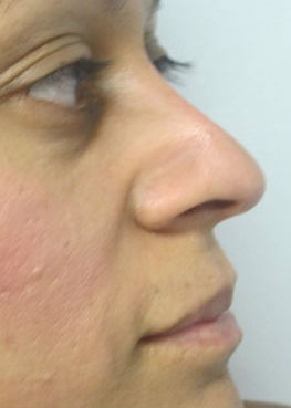 Rhinoplasty