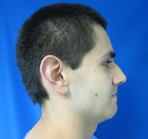 Rhinoplasty