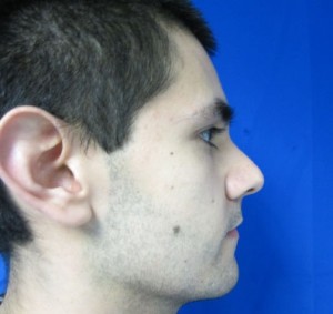 Rhinoplasty
